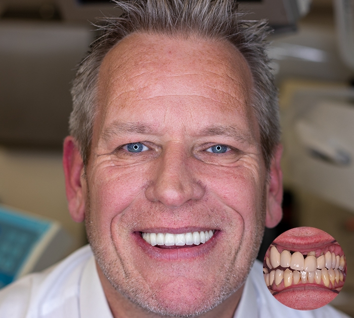 After having Cosmetic Dentistry treatment