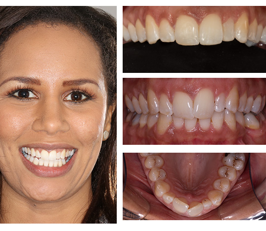 invisalign-5