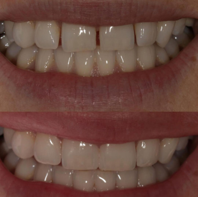 teeth-bonding-twyford-part-